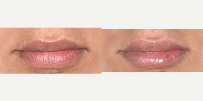 Lip Fillers before and after photo