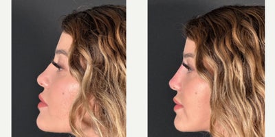 Nonsurgical Nose Job before and after photo