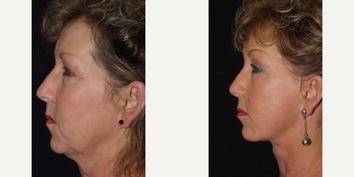 Facelift before and after photo
