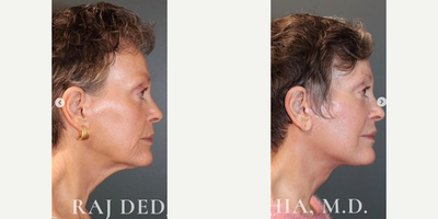 Neck Lift before and after photo