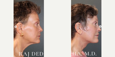 Neck Lift before and after photo