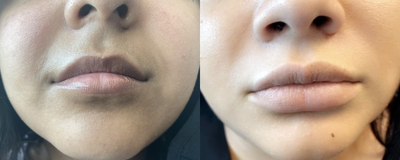 Lip Fillers before and after photo