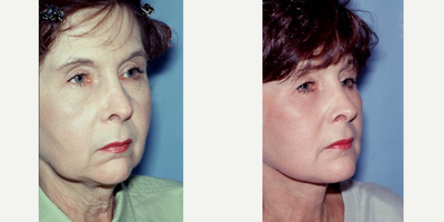 Neck Lift before and after photo