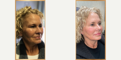 Radiesse before and after photo