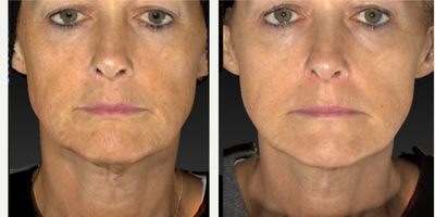 Ultherapy before and after photo
