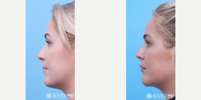 Chin Implant before and after photo