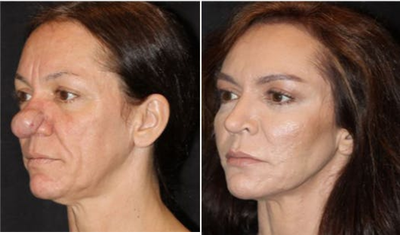 CO2 Laser before and after photo