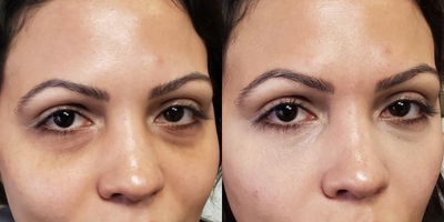 Dermal Fillers before and after photo