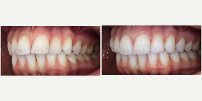 Invisalign before and after photo