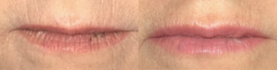 Lip Fillers before and after photo
