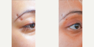 Microneedling before and after photo