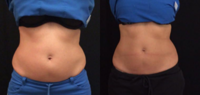 CoolSculpting before and after photo