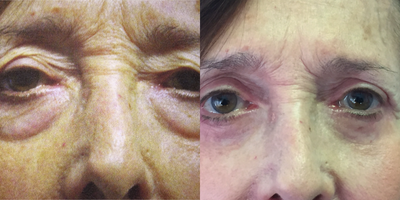 Eyelid Surgery before and after photo