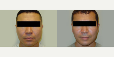 Jaw Reduction before and after photo