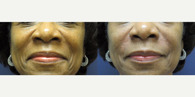 Juvederm before and after photo
