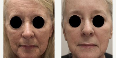 Laser Resurfacing before and after photo
