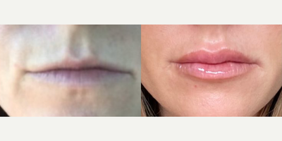 Lip Fillers before and after photo