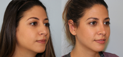 Rhinoplasty before and after photo