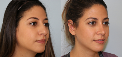 Rhinoplasty before and after photo