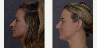 Rhinoplasty before and after photo