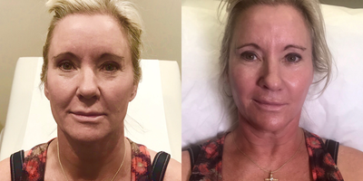Skin Rejuvenation before and after photo