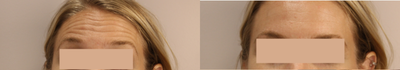 Botox before and after photo