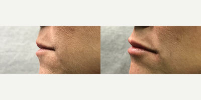 Dermal Fillers before and after photo