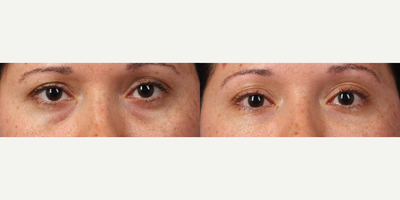 Dermal Fillers before and after photo