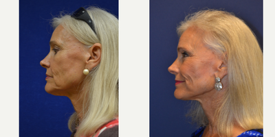 Facelift before and after photo