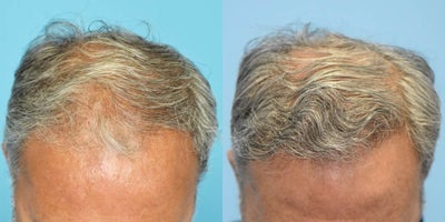 Hair Transplant before and after photo