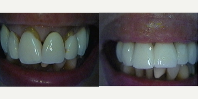 Porcelain Veneers before and after photo