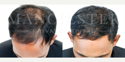 PRP for Hair Loss before and after photo