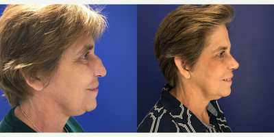 Rhinoplasty before and after photo