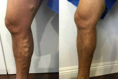 Sclerotherapy before and after photo