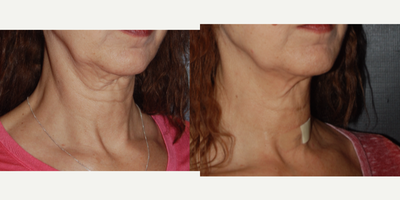 ThermiSmooth Face before and after photo