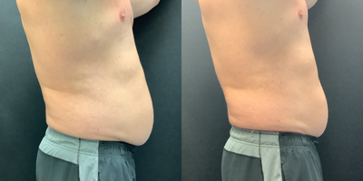 Emsculpt before and after photo