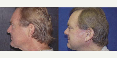 Facelift before and after photo