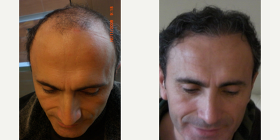 FUE Hair Transplant before and after photo