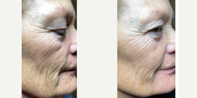 Restylane Lyft before and after photo
