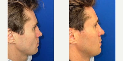 Rhinoplasty before and after photo