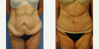 Tummy Tuck before and after photo
