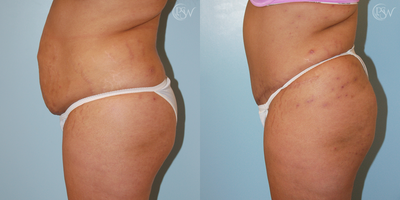 Tummy Tuck before and after photo
