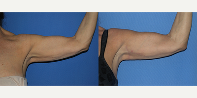 Arm Lift before and after photo