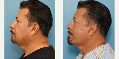 Deep Plane Facelift before and after photo