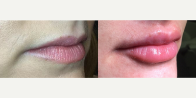 Dermal Fillers before and after photo