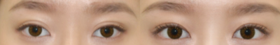 Double Eyelid Surgery before and after photo