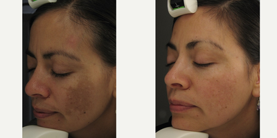 Laser Genesis before and after photo