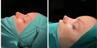Rhinoplasty before and after photo