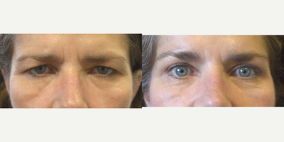 Brow Lift before and after photo