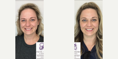 Dermal Fillers before and after photo